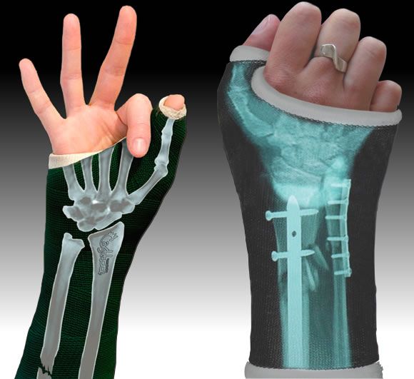 Castoo transforma o gesso de seu braço quebrado em uma máquina de raio-X.